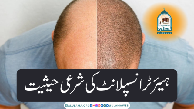 ہیئر ٹرانسپلانٹ کی شرعی حیثیت