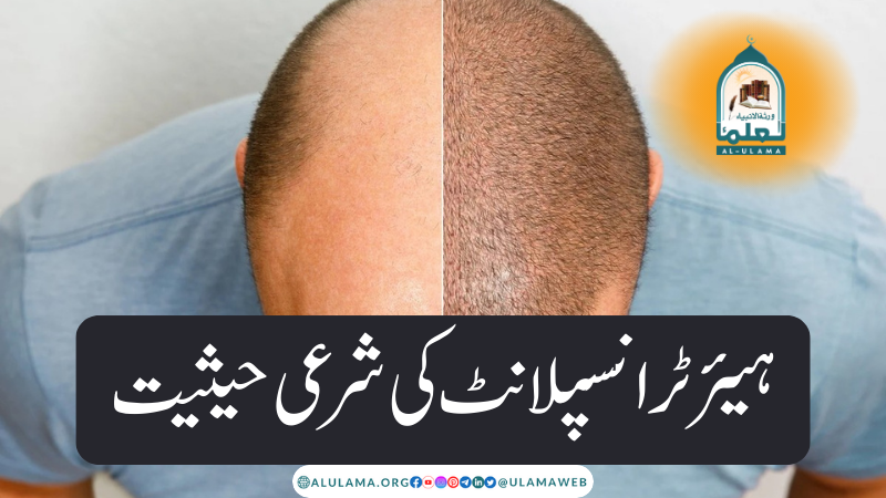 ہیئر ٹرانسپلانٹ کی شرعی حیثیت