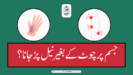 جسم پر چوٹ کے بغیر نیل پڑ جانا؟